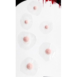 Cyst