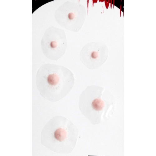 Cyst