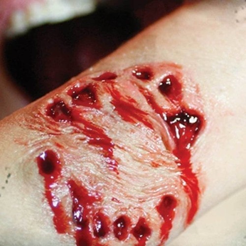 Human Bite