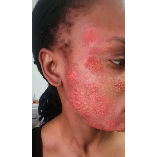 Inflammation