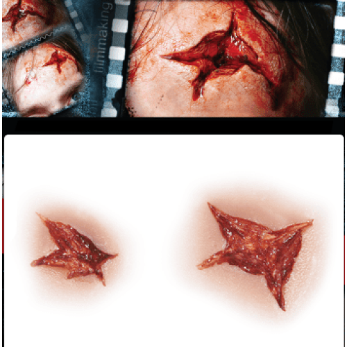 STAR INJURY