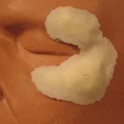Swollen Cheeks Left