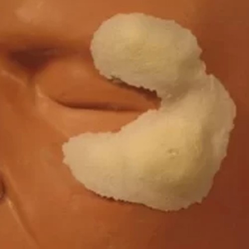 Swollen Cheeks Left