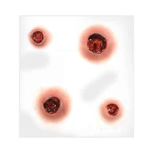 Bullet Wound